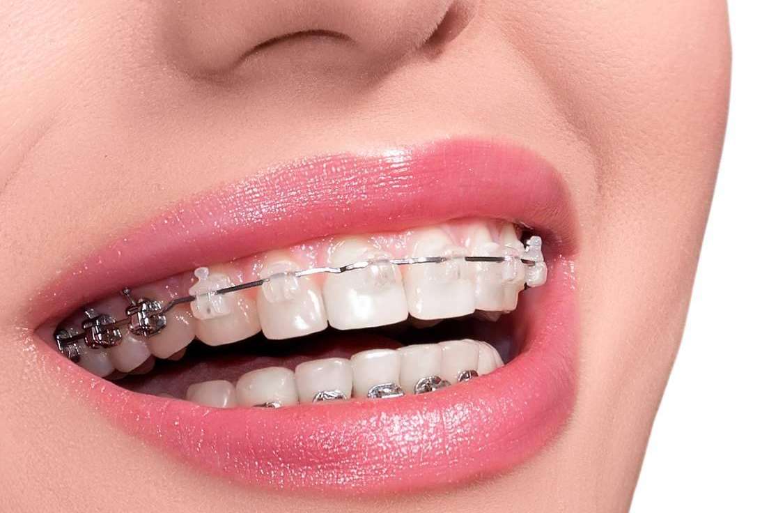 Helident Clínica Dental pone a disposición múltiples opciones de tratamiento de ortodoncia con brackets
